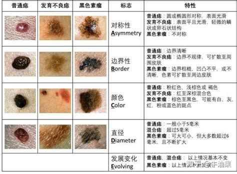 胸部長黑痣|痣是什麼？會變成黑色素瘤？7種一定要除的痣